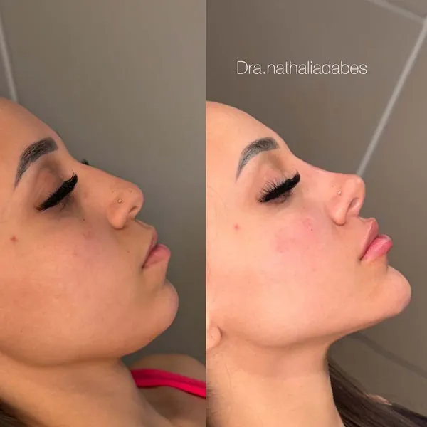 Resultado de harmonização facial na Skyn Estética