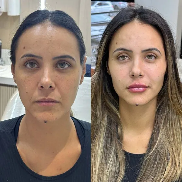 Resultado de harmonização facial com técnica natural