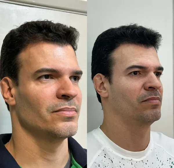Resultado de procedimento estético facial na Skyn