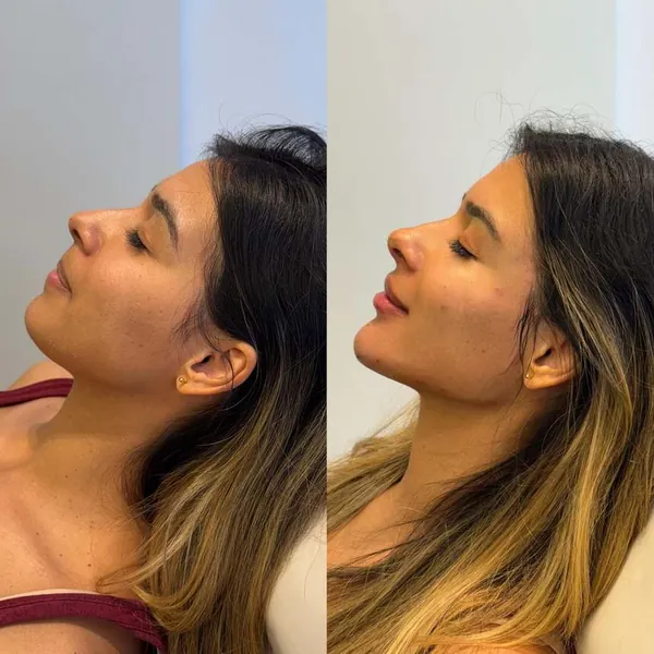 Resultado de tratamento facial na clínica Skyn