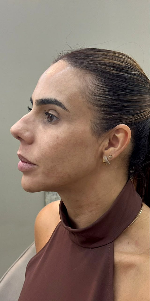 Paciente de perfil, antes do procedimento.