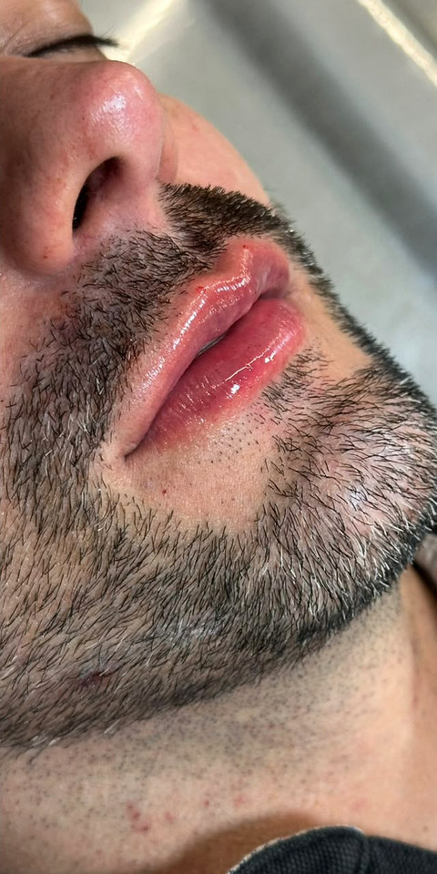 O mesmo paciente, mesma sessao fotografica, depois do procedimento.