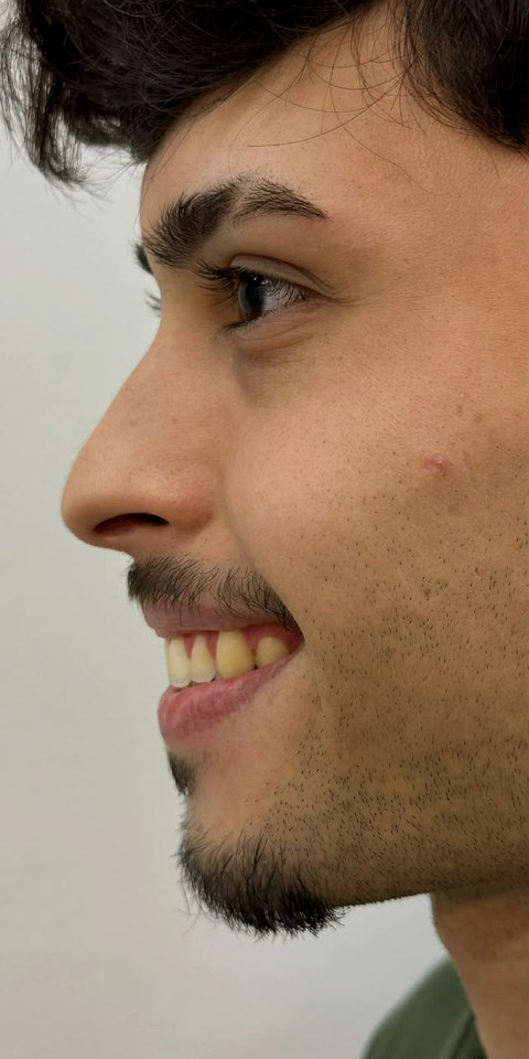 Paciente de perfil, antes do procedimento.