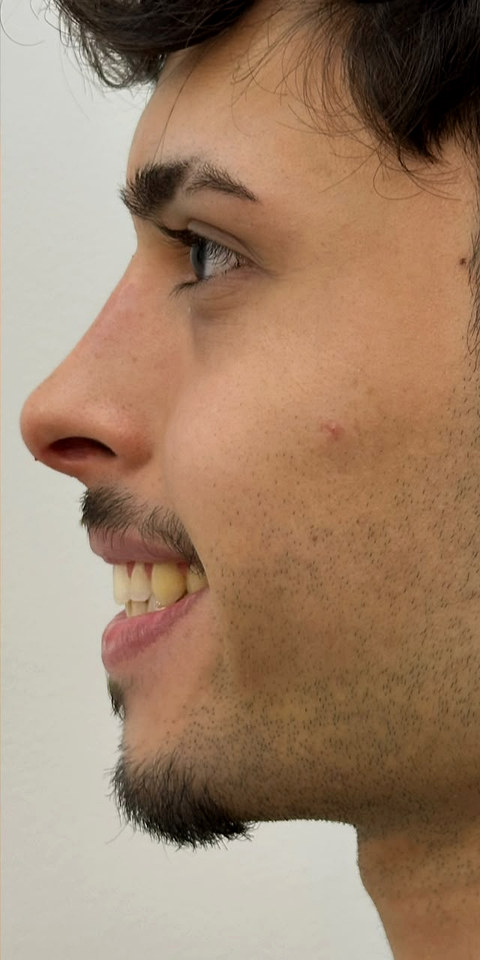 O mesmo paciente de perfil, mesma sessao fotografica, depois do procedimento.