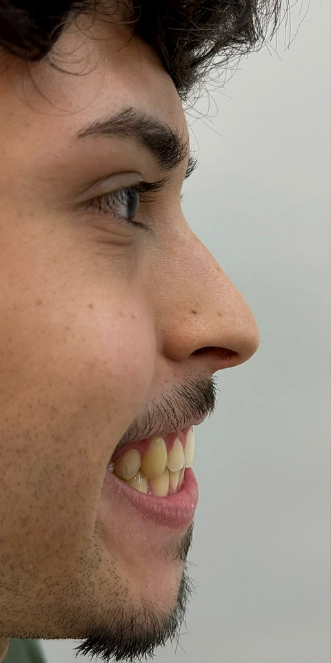 Paciente de perfil, antes do procedimento.