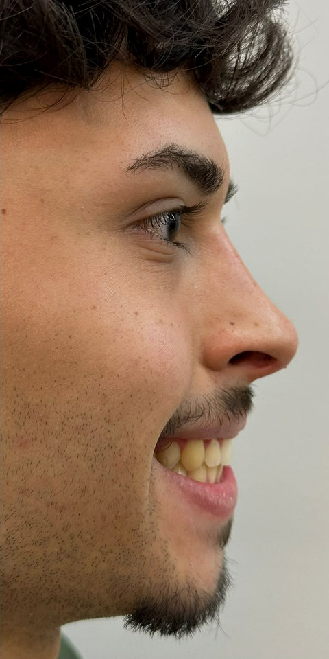 O mesmo paciente de perfil, mesma sessao fotografica, depois do procedimento.