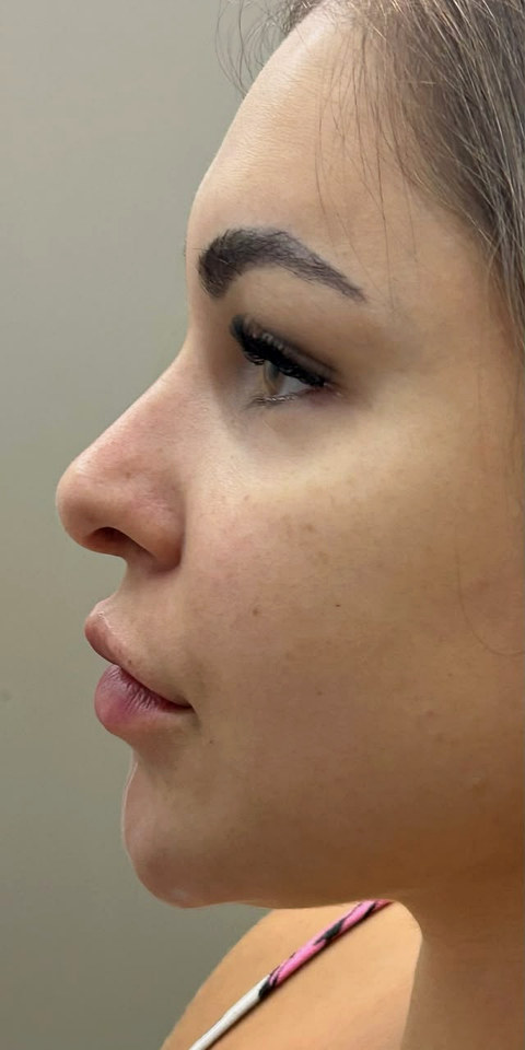 Paciente de perfil, antes do procedimento.