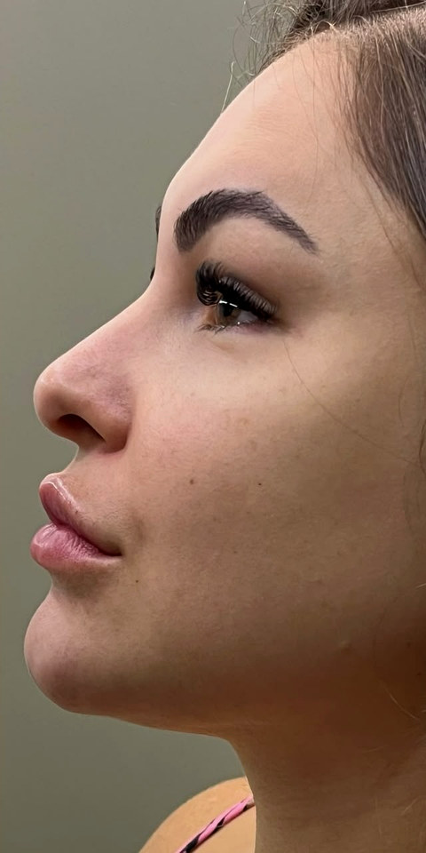 O mesmo paciente de perfil, mesma sessao fotografica, depois do procedimento.